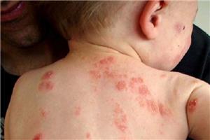 6 bệnh ngoài da hay gặp ở trẻ mùa nắng nóng mẹ cần lưu ý