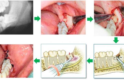 Răng khôn mọc lệch và những biến chứng nguy hiểm cho sức khỏe