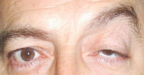 Sụp mí mắt là dấu hiệu của nhiều bệnh lý nguy hiểm