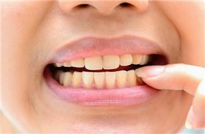 Dừng ngay 5 thói quen thường ngày này nếu không muốn men răng bị phá hủy