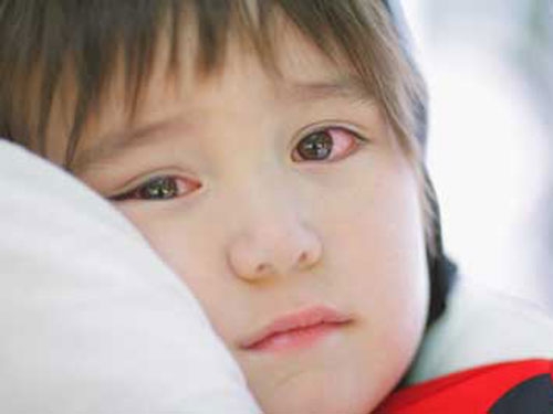 Đau mắt đỏ không nên tự chữa sẽ khiến bệnh biến chứng nặng