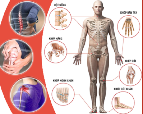 Bệnh cơ xương khớp - Một trong những nguyên nhân hàng đầu gây tàn phế