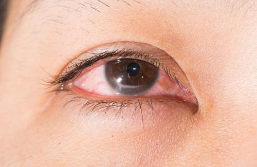 Nhìn vào mắt người bị đau mắt đỏ là bị đau mắt có phải không?