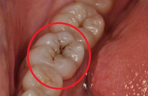 Mẹo nhỏ giảm tình trạng ê buốt, sâu răng cực kỳ hiệu quả