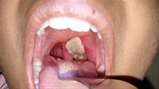 Viêm họng là dấu hiệu của bệnh dịch bạch hầu đang bùng phát