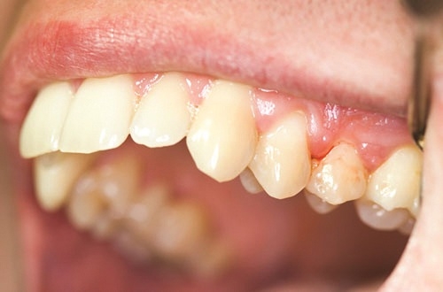 Vệ sinh răng miệng kém sẽ dễ bị mắc bệnh viêm nha chu