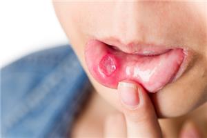 Một số bài thuốc đông y đơn giản trị chứng viêm loét miệng
