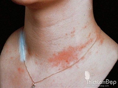 Cách loại bỏ chứng phát ban vùng da cổ nhanh và an toàn nhất