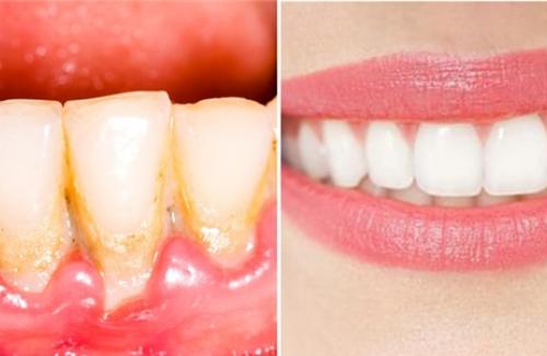Mẹo vặt giúp bạn đánh bay vết ố vàng trên răng mà không cần đến nha sĩ