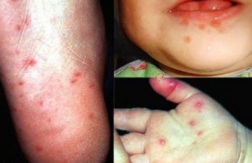 Triệu chứng và cách phòng ngừa bệnh tay chân miệng cho trẻ
