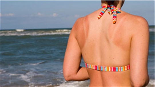 Chuyên gia chỉ cách chăm sóc da khi bị bỏng nắng hiệu quả