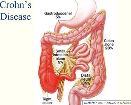 Bệnh Crohn là gì? Thuốc lá và nguy cơ mắc bệnh Crohn