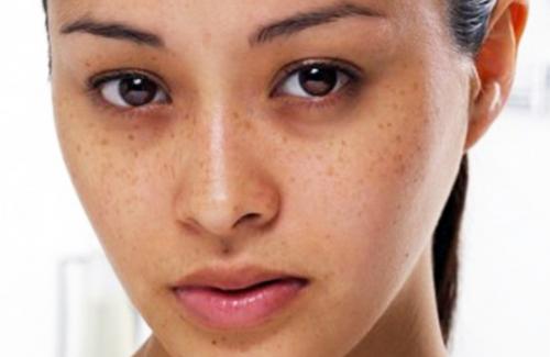 6 bí quyết giúp da mặt không bao giờ bị nám không thể bỏ qua
