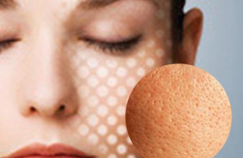 8 nguyên liệu khắc phục lỗ chân lông to giúp làn da mềm mại và mịn màng hơn