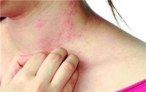 Các bệnh về da thường gặp trong mùa hè và biện pháp xử lý