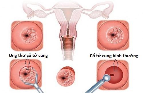 Hãy cùng tìm hiểu nguyên nhân gây ung thư cổ tử cung để phòng tránh nhé!