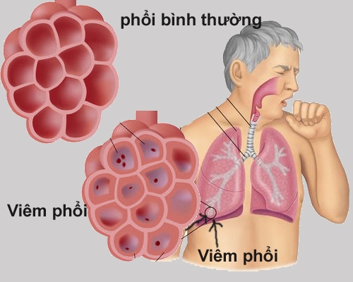 Bệnh viêm phổi có lây không và cách phòng tránh như thế nào?