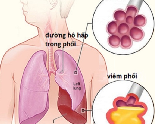 6 bệnh viêm phổi - phế quản thường gặp và cách phòng tránh