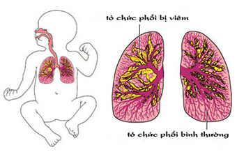 Nhận biết viêm phổi ở trẻ em để điều trị kịp thời cho con nhanh khỏi bệnh