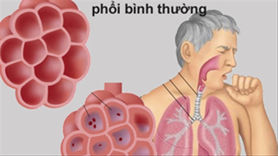 8 dấu hiệu của bệnh viêm phổi bạn không nên bỏ qua