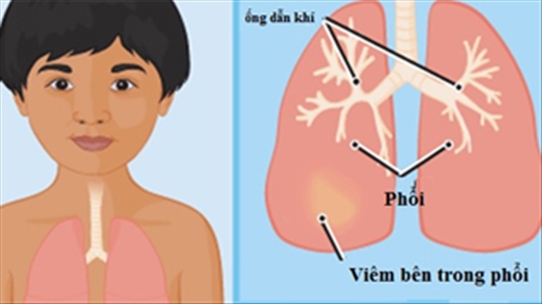 Ngăn chặn viêm phổi ở trẻ như thế nào cho hiệu quả nhất
