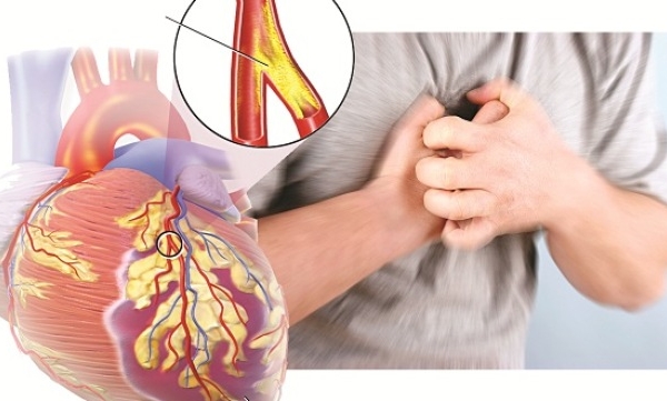 Bệnh động mạch vành: Nguyên nhân và các triệu chứng
