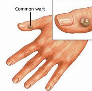 Bệnh ngoài da thường gặp: Bệnh hạt cơm là gì - cách điều trị