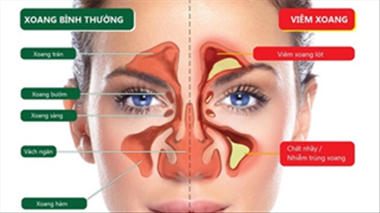 Viêm xoang, viêm mũi dị ứng: Đừng buông xuôi! Đây là giải pháp cho bạn