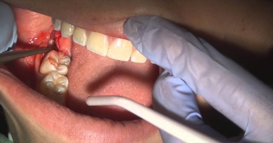 Có thể tử vong vì nhổ một chiếc răng số 8 hay không?