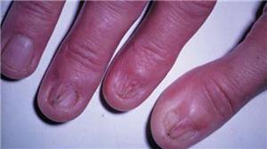 Cảnh báo nguyên nhân dẫn đến bệnh Lichen phẳng - căn bệnh viêm da chưa có cách điều trị