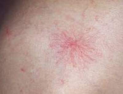 Biểu hiện ngoài da ở người bệnh gan cần chú ý để điều trị kịp thời