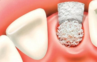 Viêm tủy răng dễ dẫn tới nhiễm khuẩn tim và các vấn đề về tim mạch phải không?
