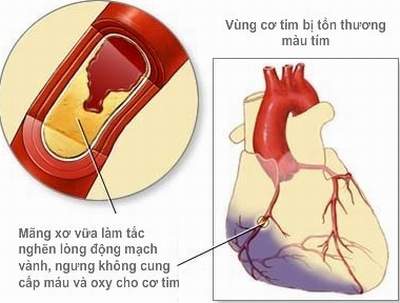 Bệnh nhồi máu cơ tim cấp - Điều trị và biện pháp phòng ngừa bệnh