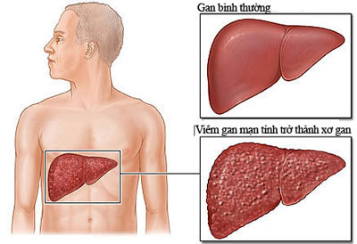 Bệnh xơ gan bắt nguồn từ đâu? Đây là câu trả lời cho bạn