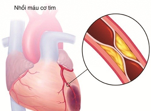 Cách phát hiện sớm nhồi máu cơ tim tránh nhầm lẫn với đột quỵ