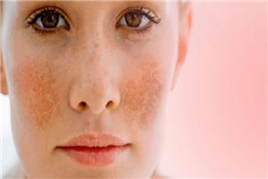Bất ngờ với hiệu quả trị nám da từ bí đao có thể áp dụng ngay tại nhà