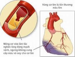Các nhóm thuốc điều trị nhồi máu cơ tim nhất định phải biết