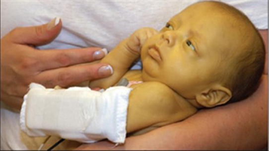 Trẻ sơ sinh bị vàng da: Khi nào mẹ phải đưa trẻ đưa trẻ đi khám sức khỏe?
