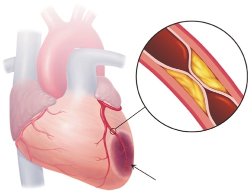 Nguyên nhân phổ biến nào gây ra bệnh động mạch vành?