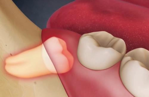 Bật mí 7 cách giúp chữa đau răng khôn cực hiệu quả
