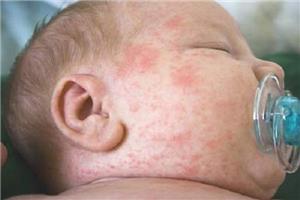 Các triệu chứng nhận biết bệnh sốt xuất huyết ở trẻ em