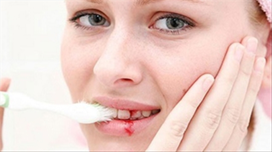 Chảy máu chân răng không chỉ là viêm lợi mà đáng sợ hơn thế