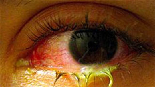 Triệu chứng, biểu hiện bệnh đau mắt đỏ bạn nhất định phải chú ý