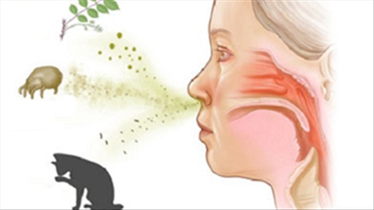 30% bệnh nhân viêm mũi dị ứng có biểu hiện của hen suyễn