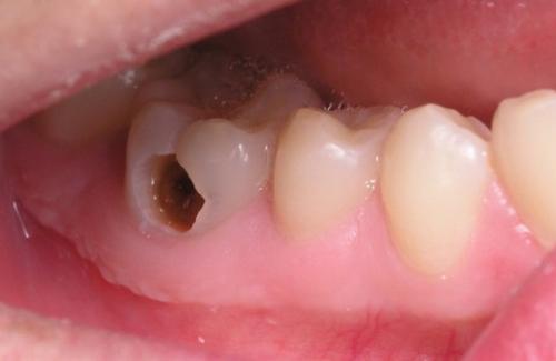 Tìm hiểu những điều bạn chưa biết về bệnh sâu răng