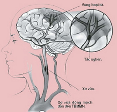 Rối loạn tuần hoàn não và các cách phòng tránh hiệu quả