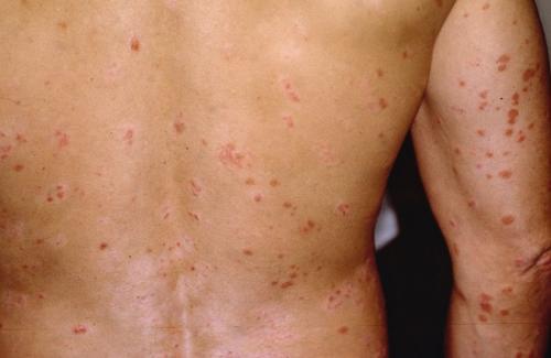 Các bệnh ngoài da thường gặp và các cách phòng chống