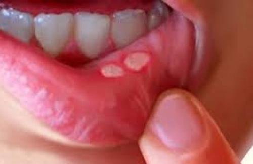 Mẹo hay chữa khỏi ngay nhiệt miệng không cần thuốc Mẹo hay chữa khỏi ngay nhiệt miệng không cần thuốc