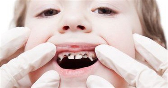 Cảnh báo 5 quan niệm sai lầm khiến trẻ bị hỏng răng ngay từ nhỏ