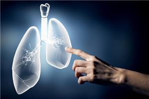 Những thực phẩm quen thuộc chứa nhiều chất asen có thể gây ung thư phổi
